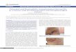 Palisaded and Neutrophilic Granulomatous Dermatitis in 