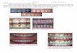 Direct composite restorations from Esthetic view