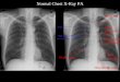 Normal Chest X-Ray PA
