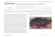 REVERSIBLE HYPOPIGMENTATION OF HAIR SECONDARY TO VITAMIN B12