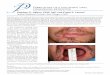 Fabrication of a unilateral oral commissure retractor