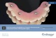 Full-arch maxillary rehabilitation on 4 implants: fast and 