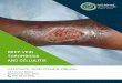Deep Vein Thrombosis Cellulitis Brochure